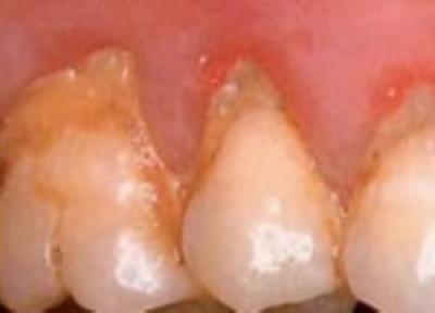 جرم و پلاک دندان جرم و پلاک دندان